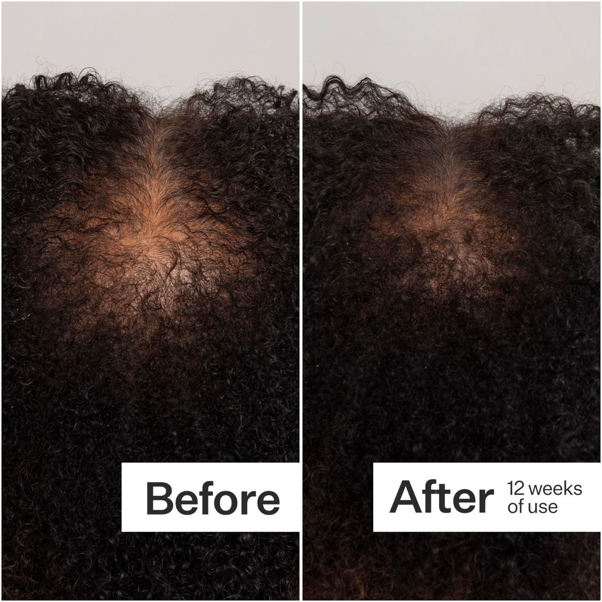 Act+Acre 0.25mm Scalp Dermaroller SkinShop
