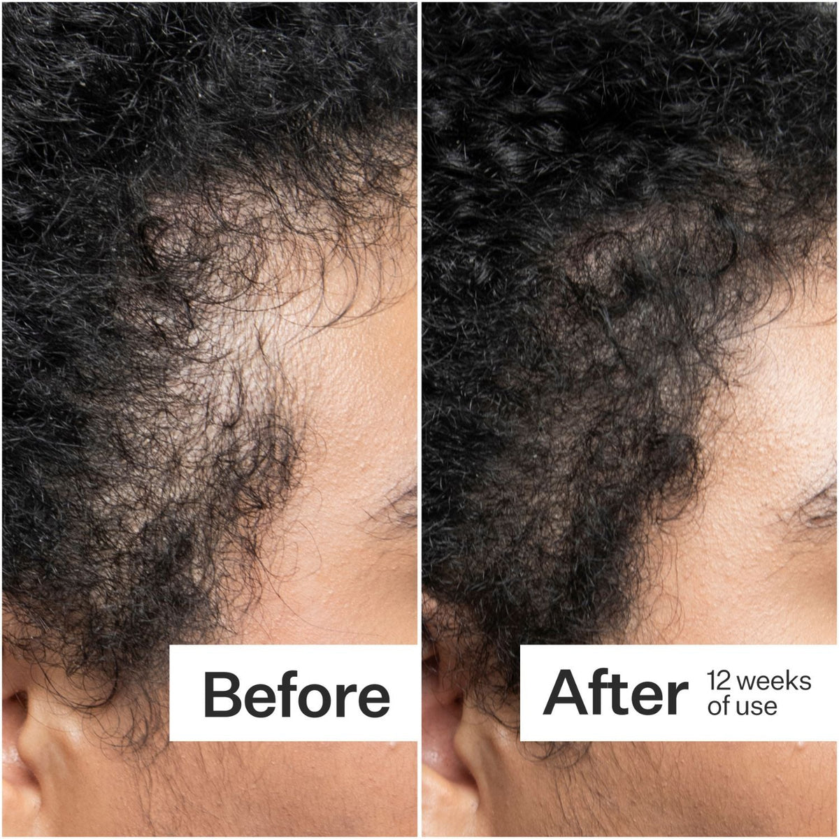 Act+Acre 0.25mm Scalp Dermaroller SkinShop