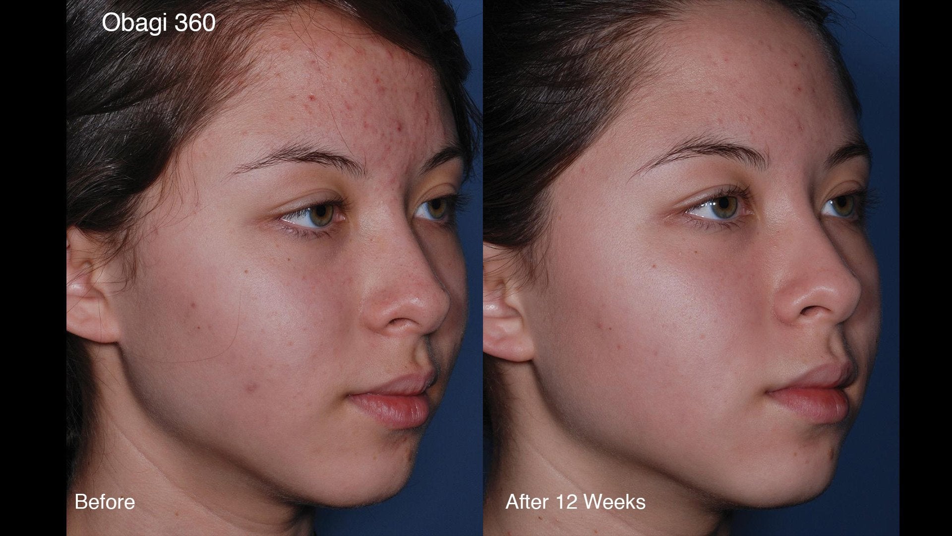 Obagi CLENZIderm Daily Foaming Cleanser Clinical results SkinShop.ie