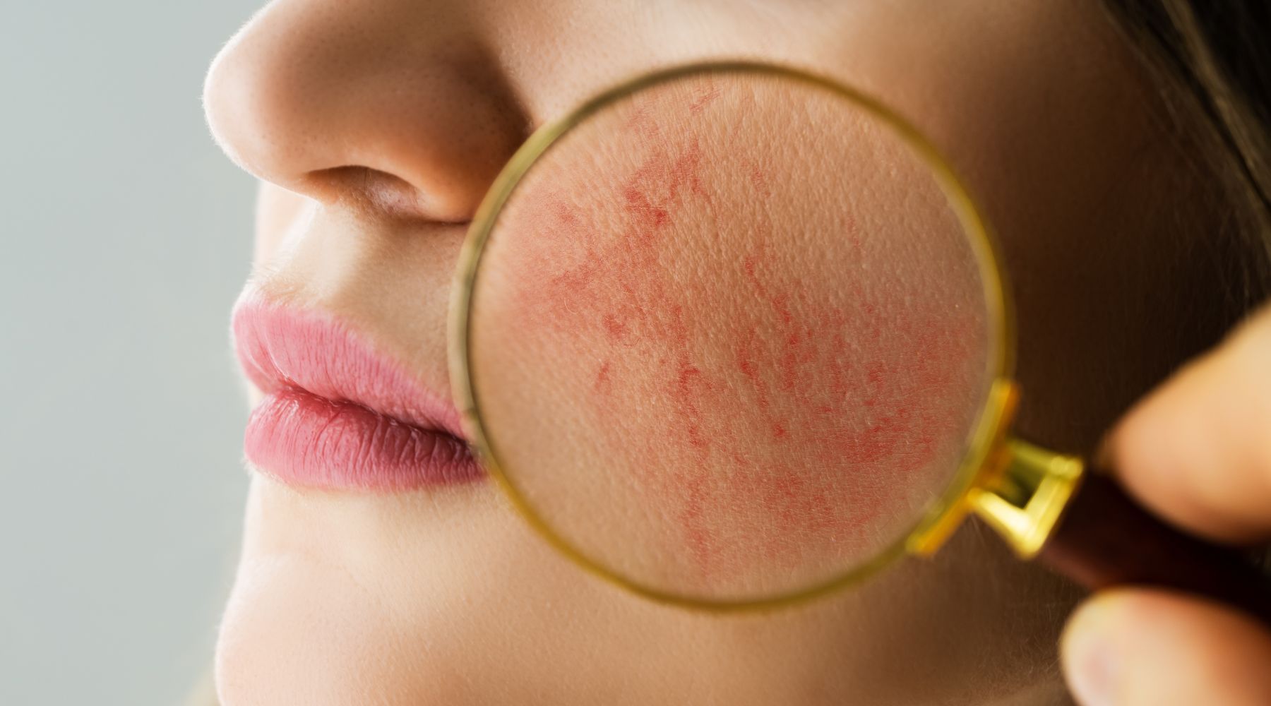 Best Skincare Products for Rosacea - SkinShop