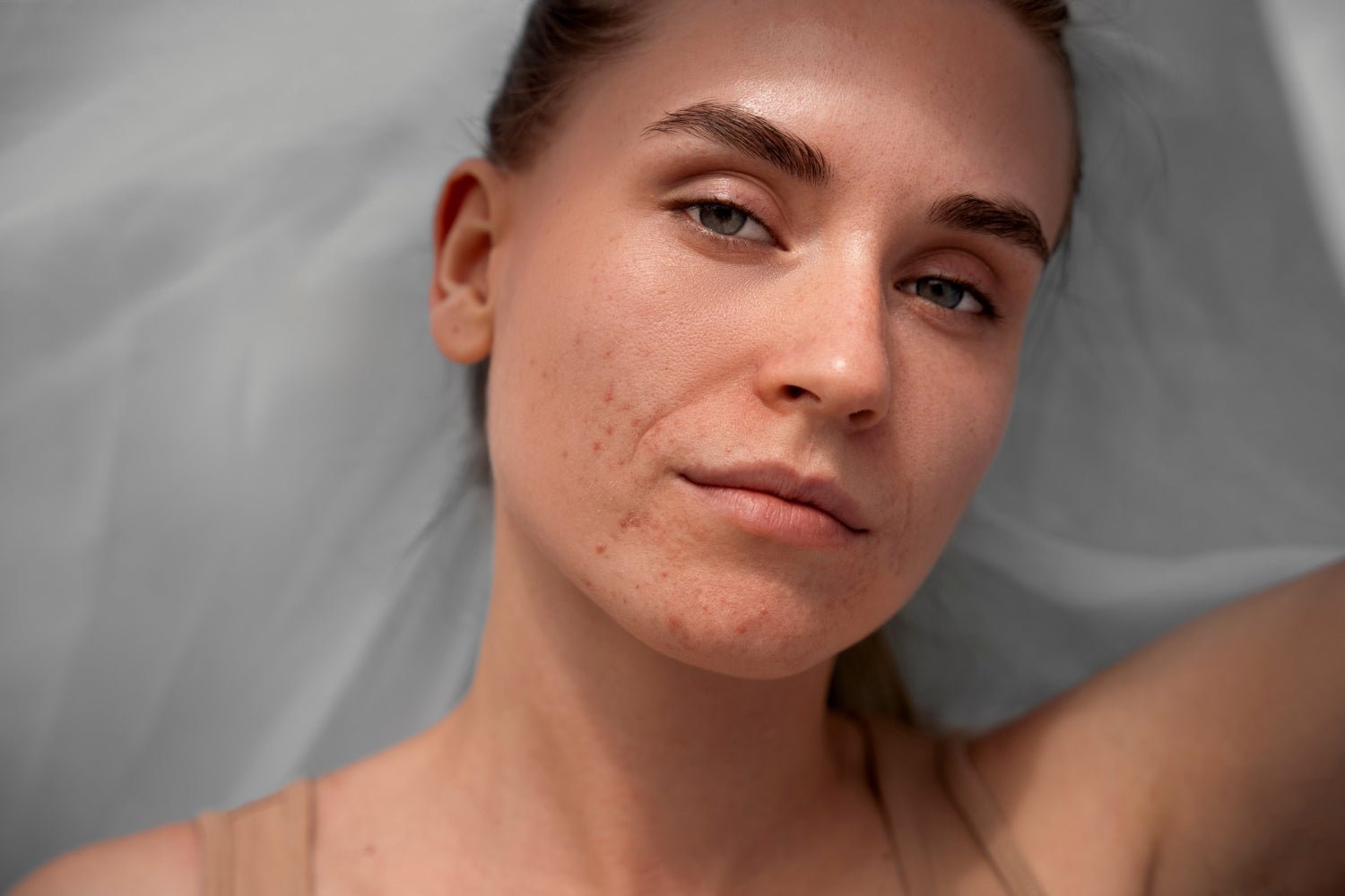 Breakouts, Be Gone: Your Expert Guide to Acne Awareness Month - SkinShop