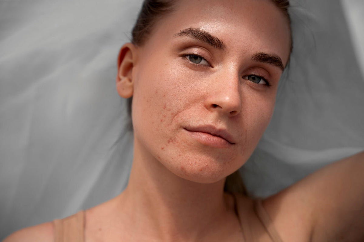 Breakouts, Be Gone: Your Expert Guide to Acne Awareness Month - SkinShop