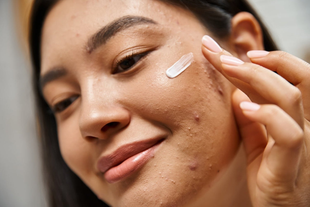 The Clear-Skin Guide to Sun Protection: Top Acne-Safe SPFs at SkinShop - SkinShop