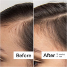 Act+Acre 0.25mm Scalp Dermaroller SkinShop