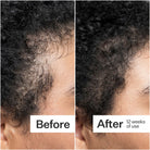 Act+Acre 0.25mm Scalp Dermaroller SkinShop