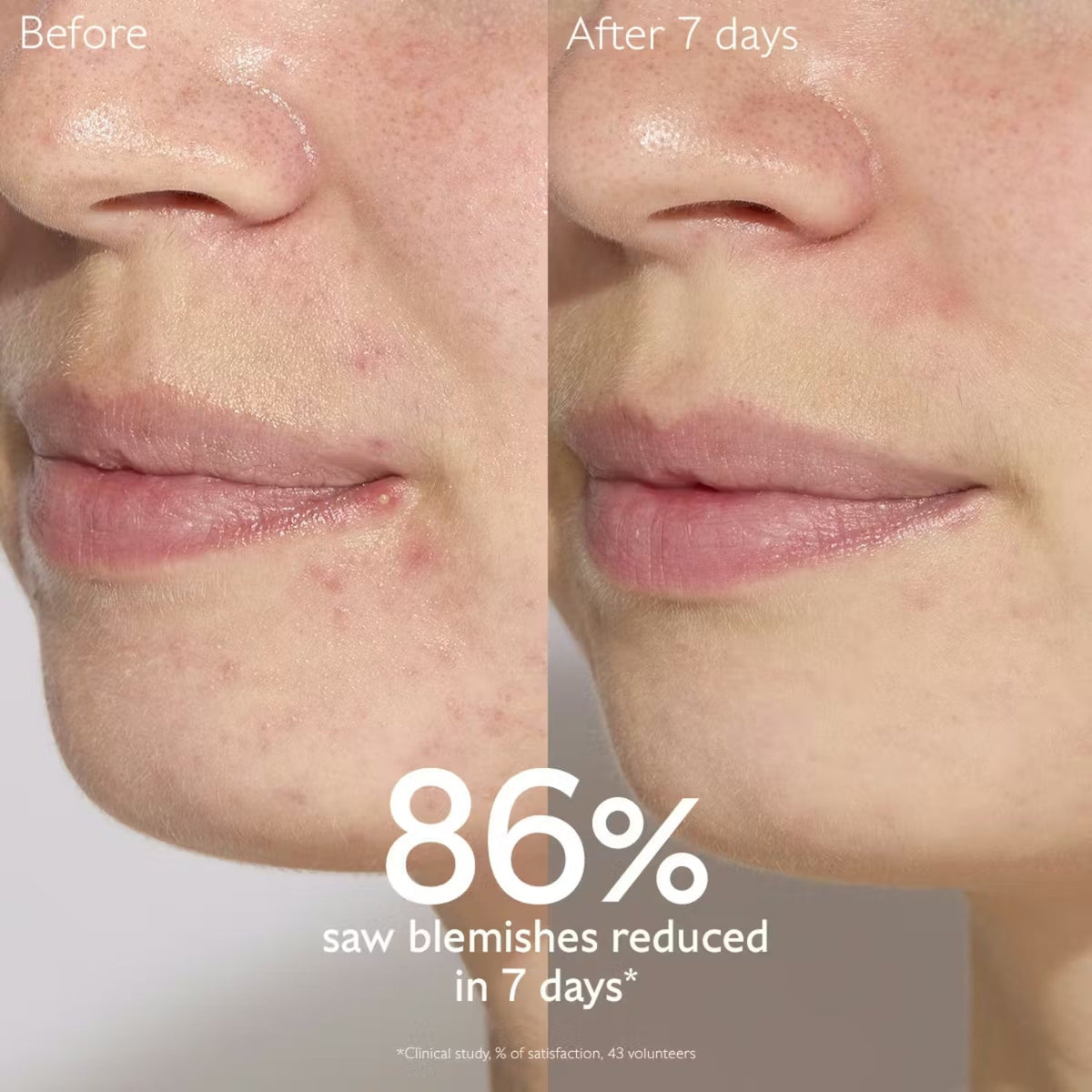 CaudalieCaudalie Vinopure Blemish Control Salicylic Serum 30mlSkinShop