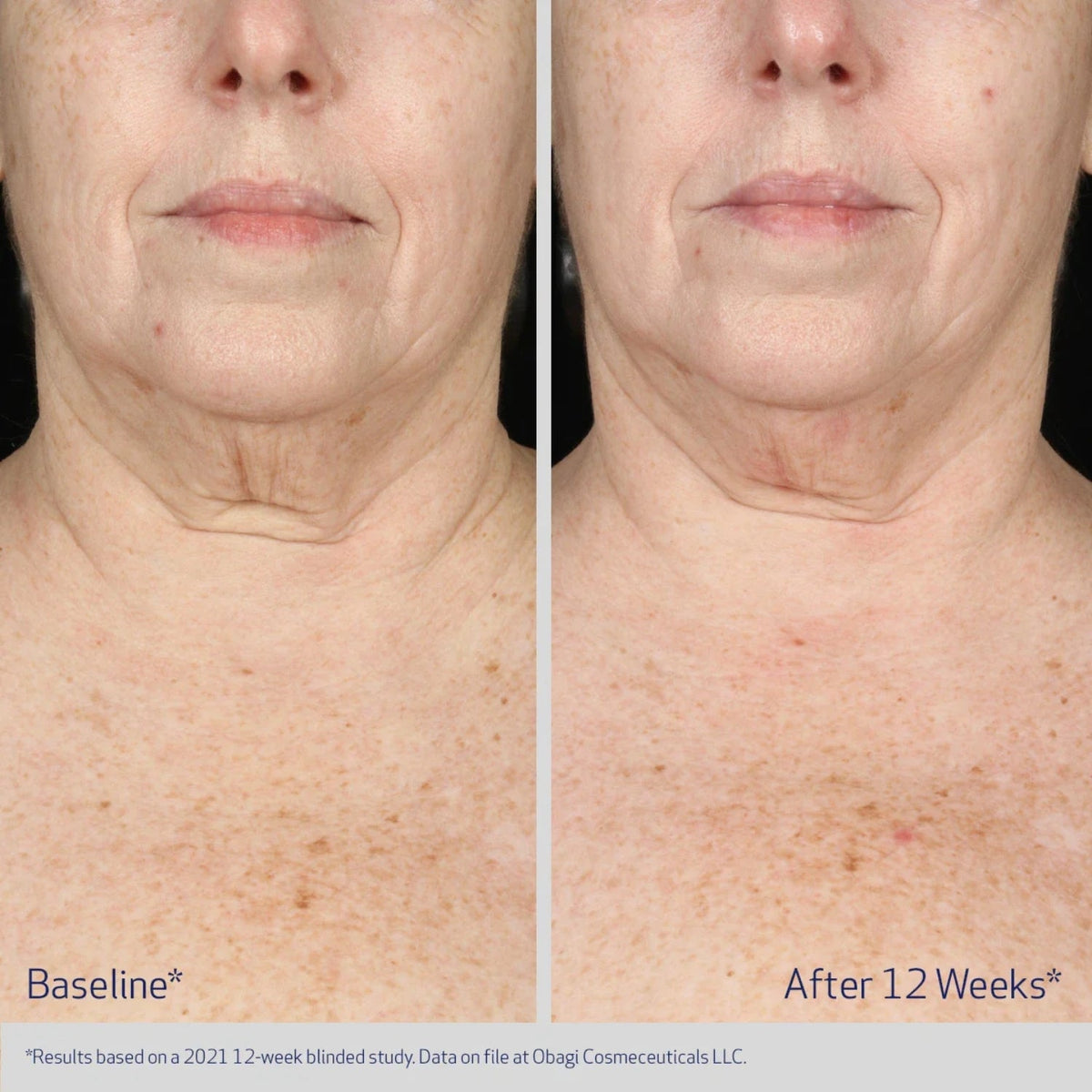 ObagiObagi ELASTIderm Neck and Decollete Concentrate 60mlSkinShop