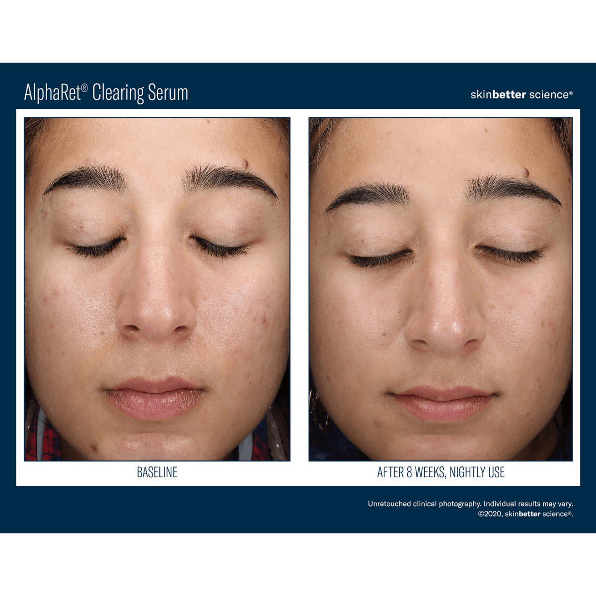 Skinbetter ScienceSkinbetter Science AlphaRet Clearing Serum 30mlSkinShop