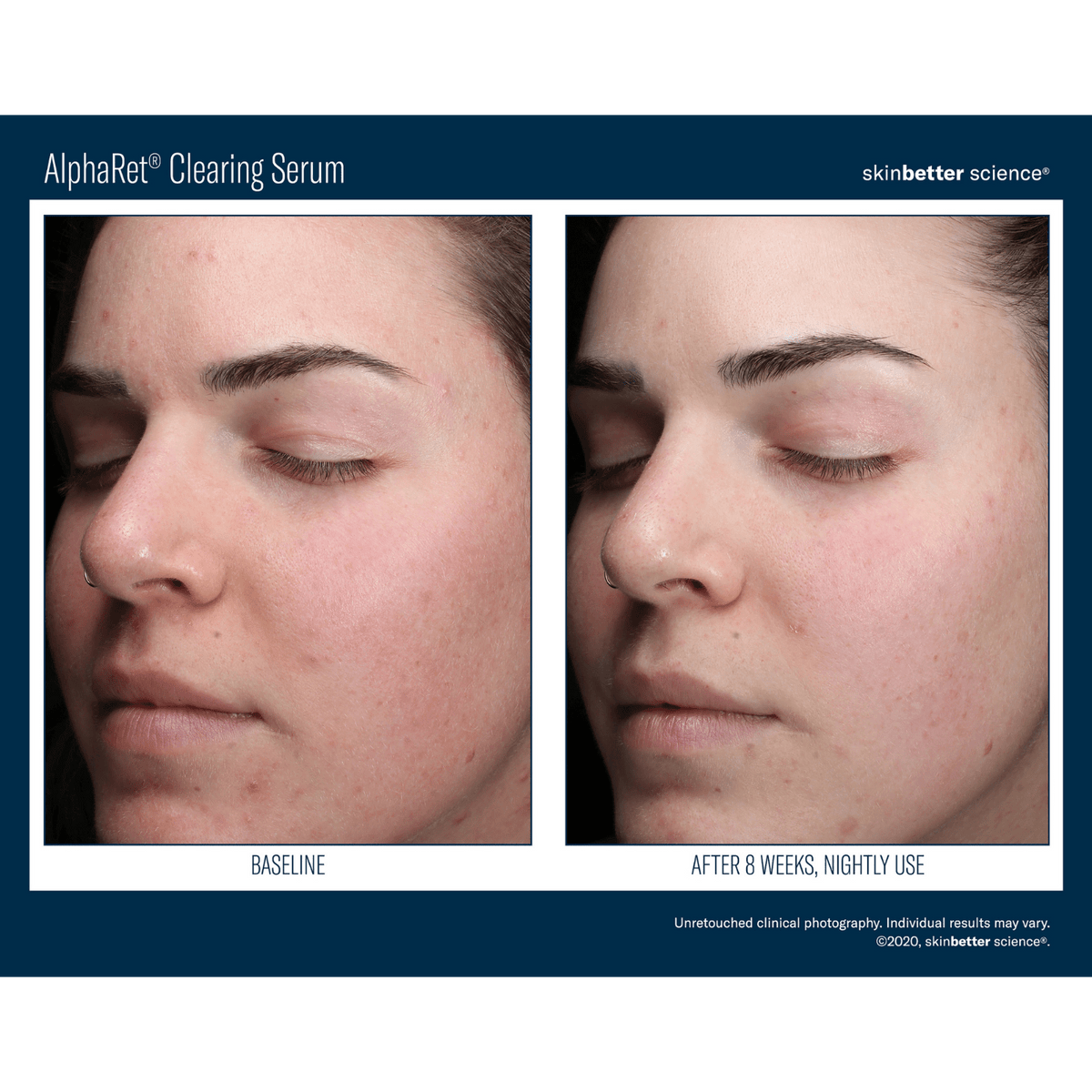 Skinbetter ScienceSkinbetter Science AlphaRet Clearing Serum 30mlSkinShop