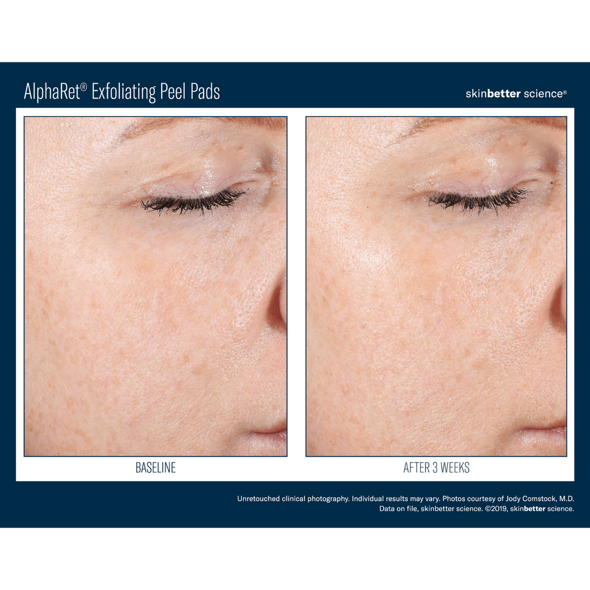 Skinbetter ScienceSkinbetter Science AlphaRet Exfoliating Peel Pads 30 PadsSkinShop