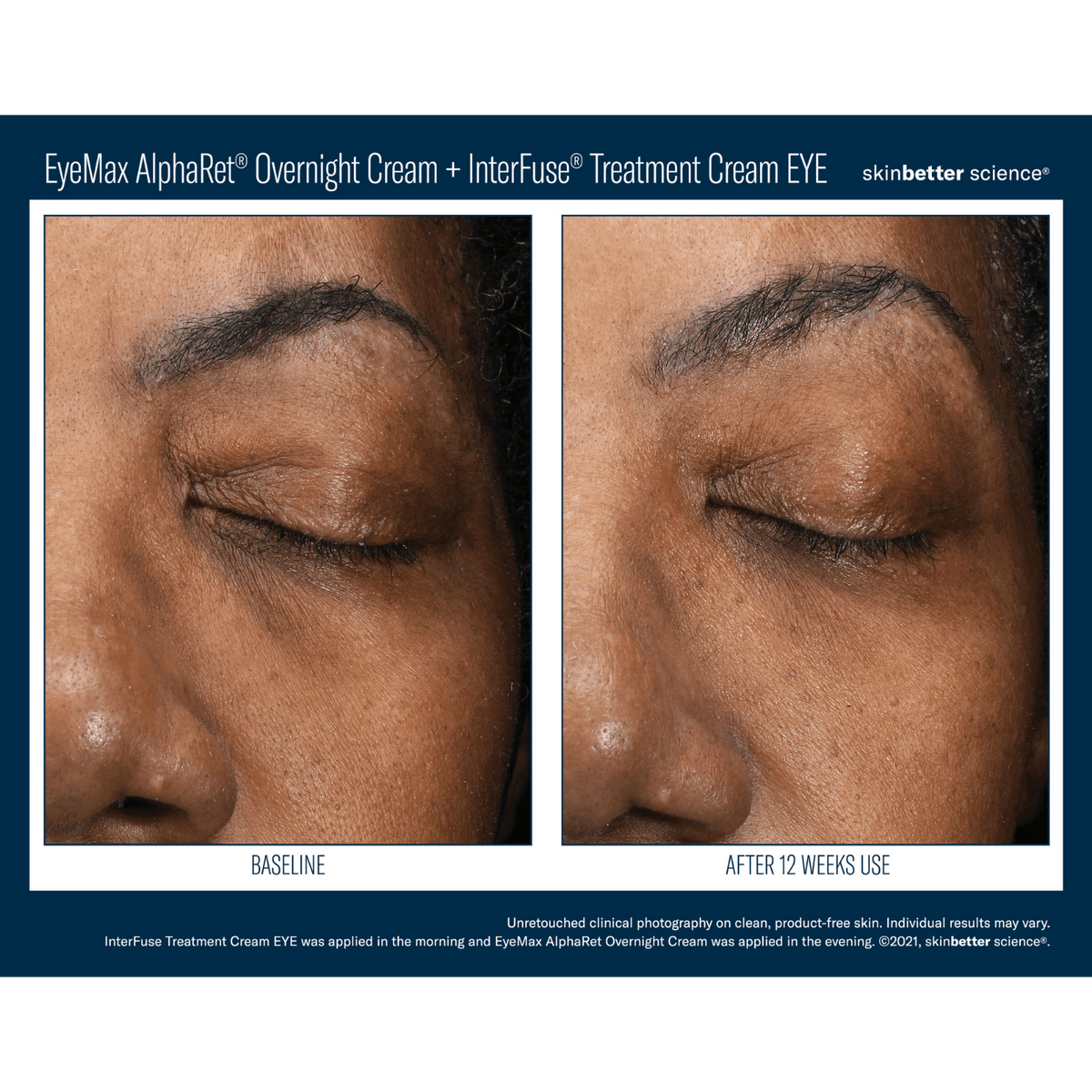 Skinbetter ScienceSkinbetter Science EyeMax AlphaRet Overnight Cream 15mlSkinShop