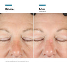 Before and after close up of the eye area showing fewer deep wrinkles after using A.G.E Interrupter Advanced