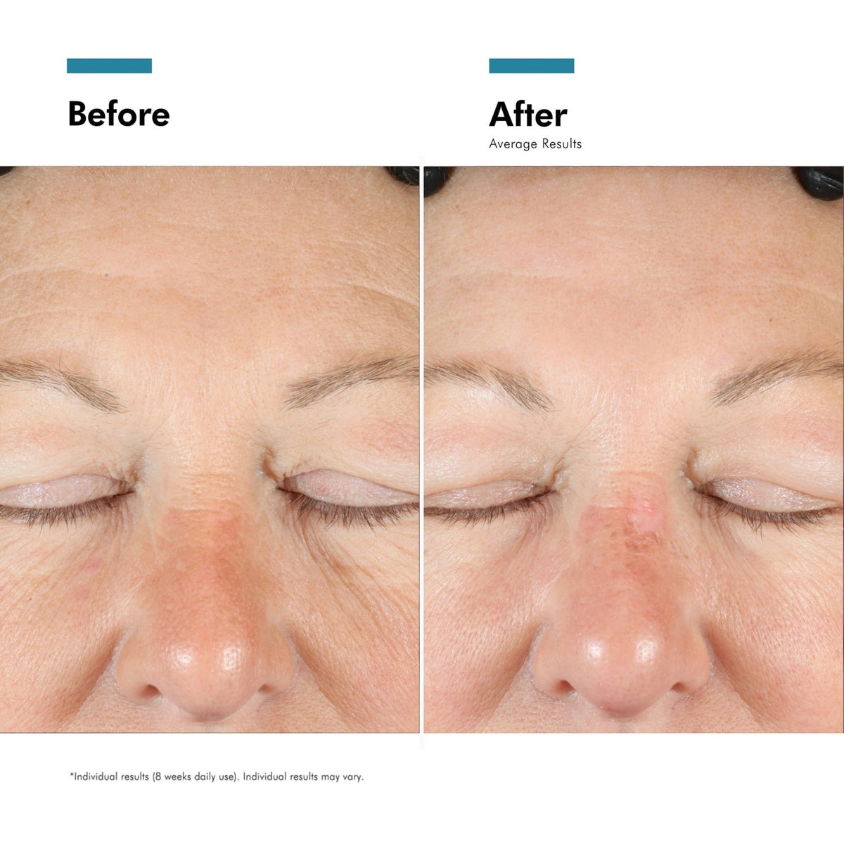 Before and after close up of the eye area showing fewer deep wrinkles after using A.G.E Interrupter Advanced