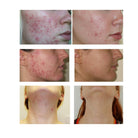 Advanced Nutrition Programme ANP Skin Accumax clinical results SkinShop.ie