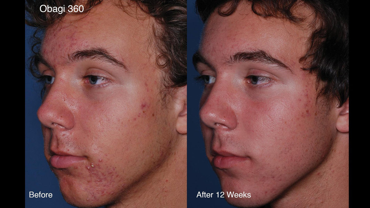 Obagi CLENZIderm Daily Foaming Cleanser Clinical results SkinShop.ie
