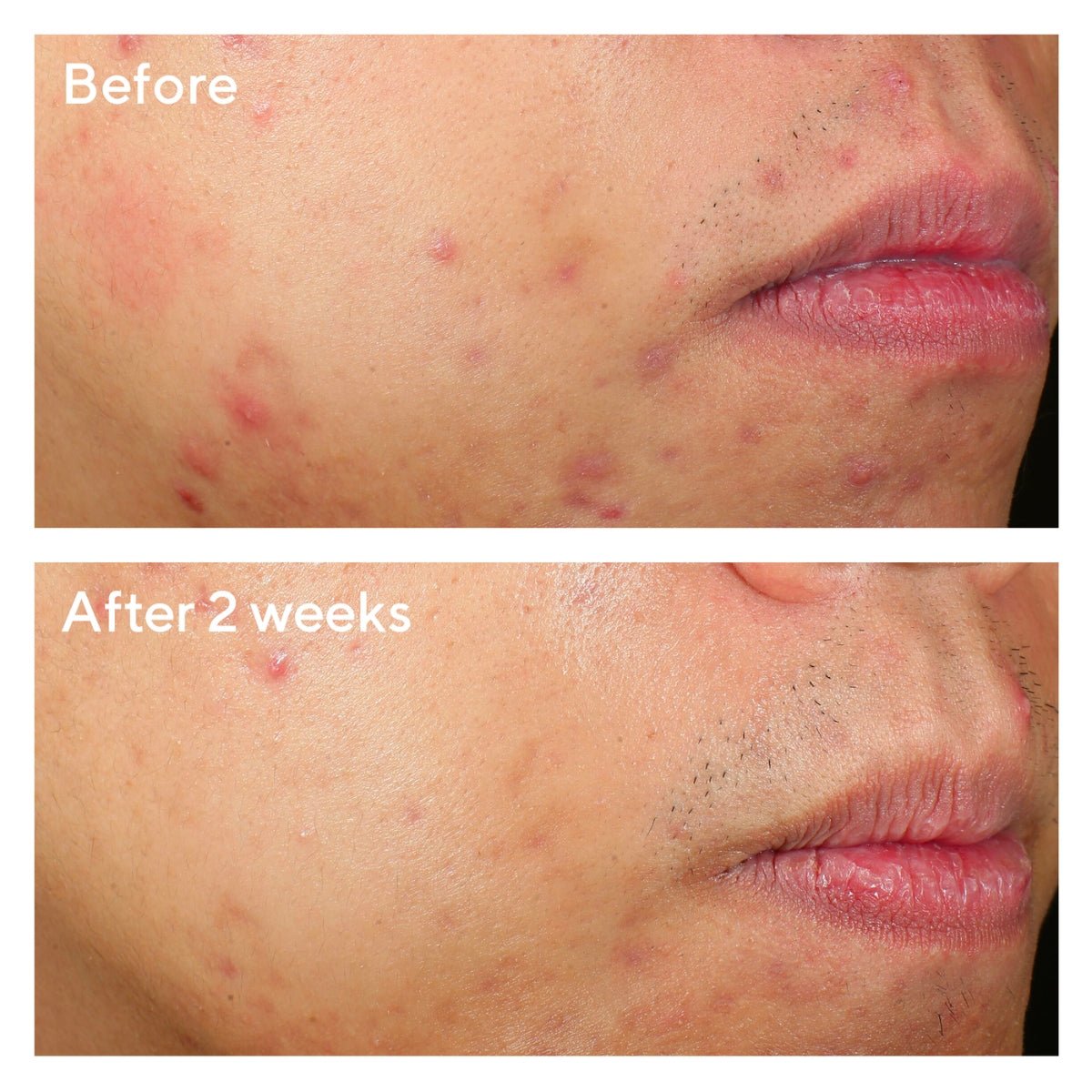 Murad Murad | Deep Relief Acne Treatment | 30ml - SkinShop