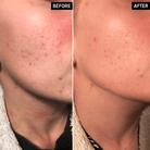 The Inkey List Apple Cider Vinegar Acid Peel | 30ml - SkinShop