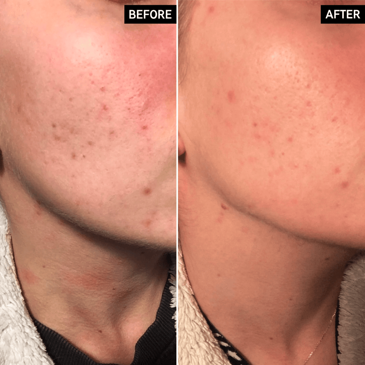 The Inkey List Apple Cider Vinegar Acid Peel | 30ml - SkinShop